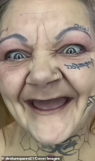 Before opting for dentures, she attempted to get dental implants, but her body reacted negatively