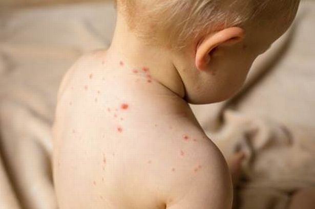 Doctors' measles warning amid 'devastating resurgence' – see the outbreaks where you live Doctors' measles warning amid 'devastating resurgence' – see the outbreaks where you live