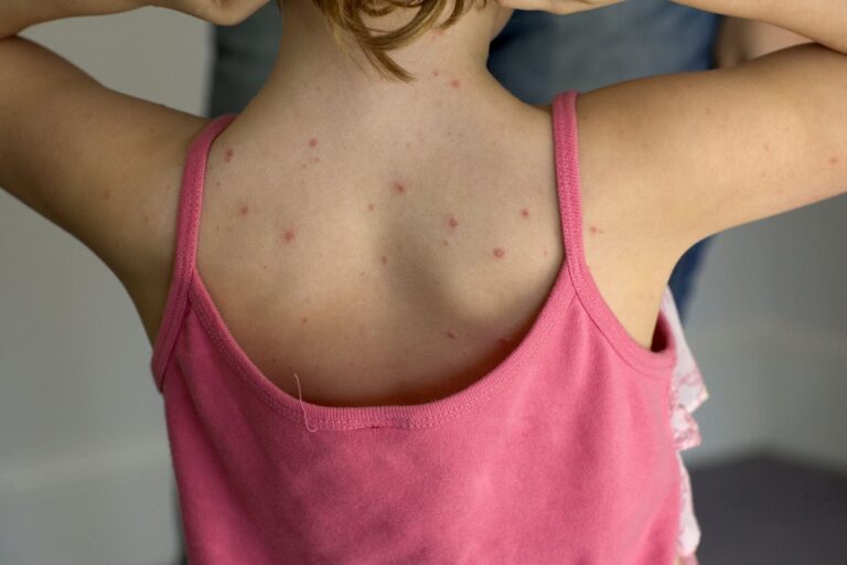 will the chickenpox vaccine be available to all children on the NHS – and who is currently eligible? – Channel 4 News