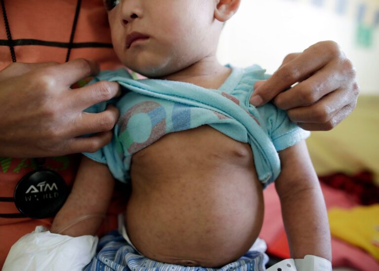 why are cases of measles rising, what are the symptoms and how safe is the MMR vaccine? – Channel 4 News why are cases of measles rising, what are the symptoms and how safe is the MMR vaccine? – Channel 4 News