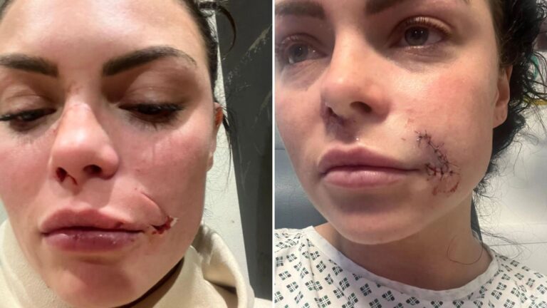My face was ‘ripped off’ by Rottweiler in vicious street attack – I needed 24 stitches & my pal now has to cough up £1k