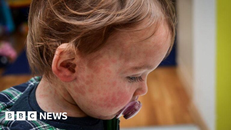 Measles: Grange Hospital patients contacted after outbreak